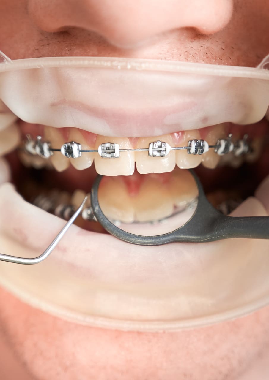 presupuesto brackets en bogota ofontologia